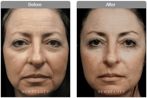 total treatment 2 before and after e1382468827468