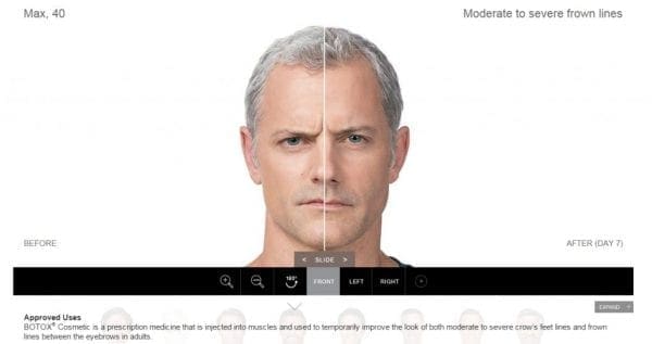 botoxformen 1024x541 1