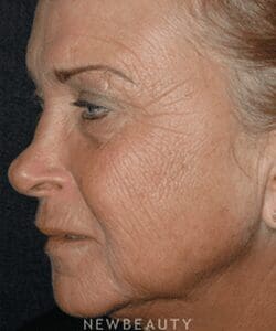 5457 dr kathleen judge skin resurfacing fractional laser
