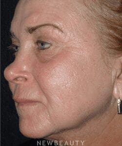 5458 dr kathleen judge skin resurfacing fractional laser